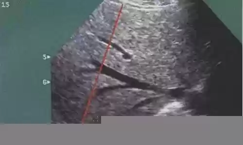肝脏正常阵容插图