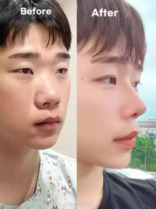 男生阵容鼻子插图